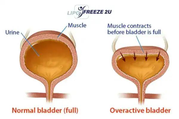 diagram of overactive bladder treatment Norfolk