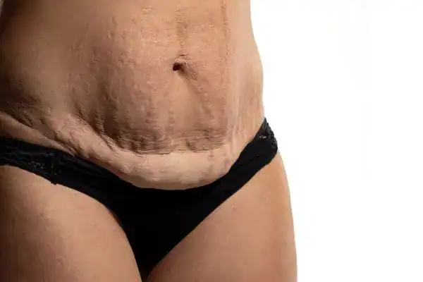 loose skin after weight loss injections Norfolk