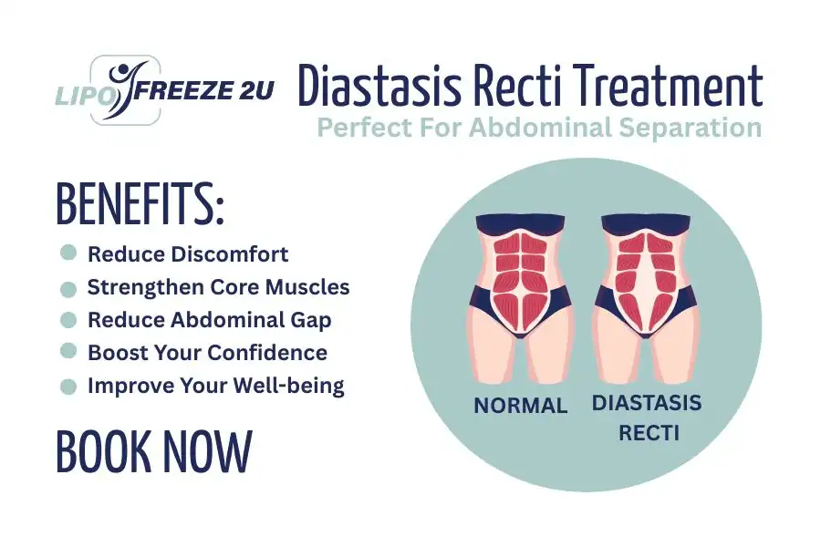 How Long Will It Take to See Improvements in Diastasis Recti Norfolk