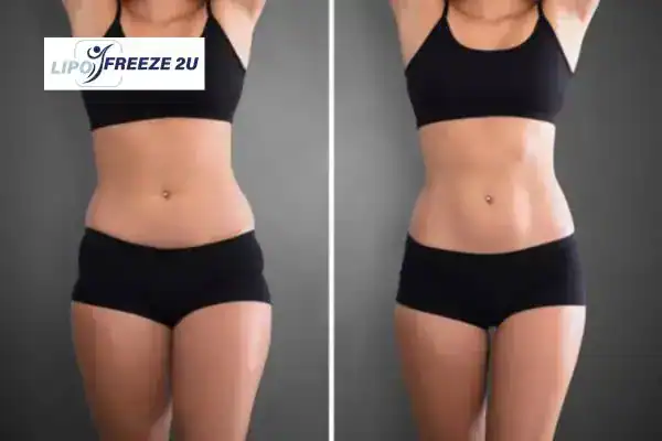 How Can LIPO FREEZE 2U Support Your Post-Pregnancy Body Recovery Norfolk?