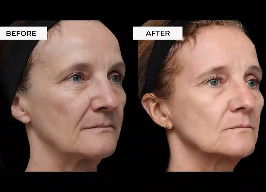 How Many RF Microneedling Sessions Will You Need to See a Difference Norfolk?
